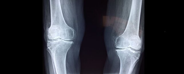 Osteoporosis Is a 'Silent Killer'. Here's How to Avoid It.