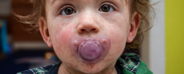 Global Measles Cases Rise by 20% as WHO Blames One Key Factor